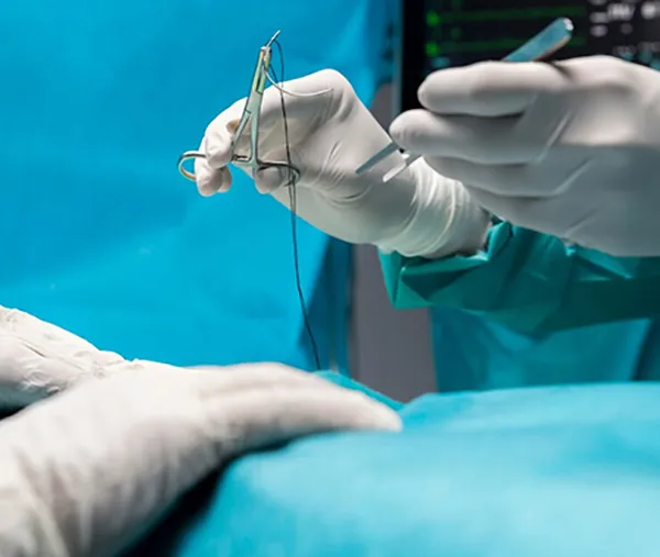 Produits de Fermeture des Plaies pour la Chirurgie gynécologique